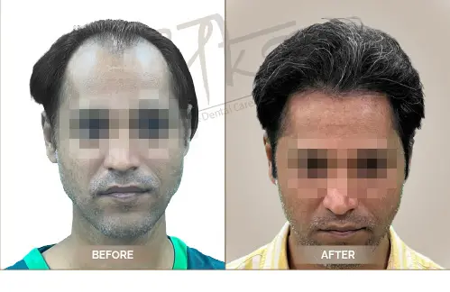 AKS Clinic Before and After AKS Clinic Before and After