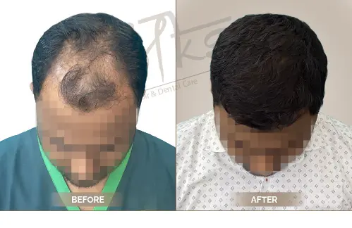 AKS Clinic Before and After AKS Clinic Before and After