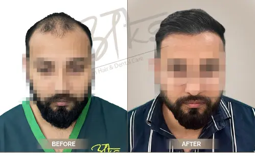 AKS Clinic Before and After AKS Clinic Before and After