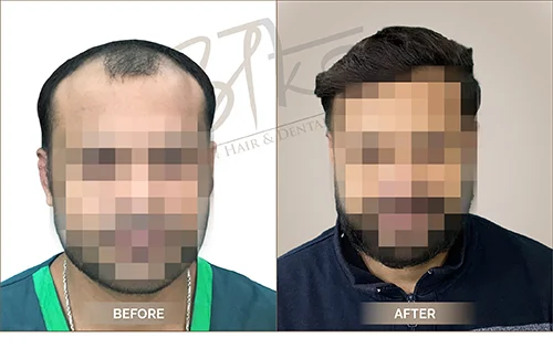 AKS clinic Before and After 3 AKS clinic Before and After 3