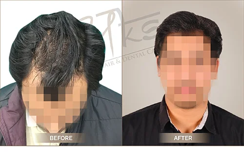 AKS clinic Before and After 1 AKS clinic Before and After 1