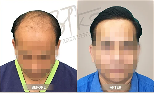 AKS clinic Before and After 5 AKS clinic Before and After 5