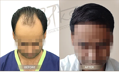 AKS clinic Before and After 2 AKS clinic Before and After 2