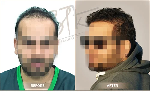 AKS clinic Before and After 12 AKS clinic Before and After 12