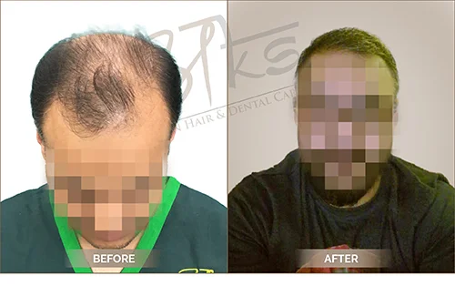 AKS clinic Before and After 16 AKS clinic Before and After 16