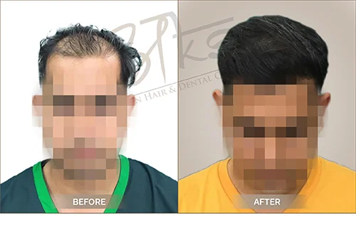 AKS clinic Before and After 11 AKS clinic Before and After 11