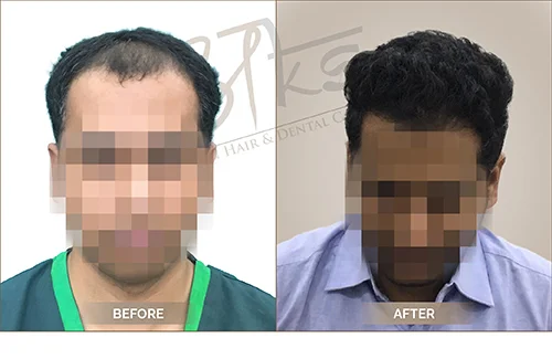 AKS clinic Before and After 15 AKS clinic Before and After 15